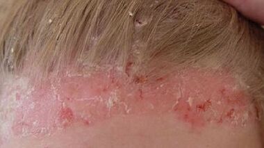 Entwicklungsstadien und Symptome der Psoriasis.