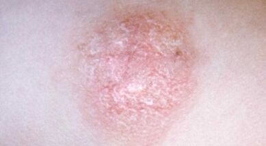 So erkennen Sie Psoriasis frühzeitig