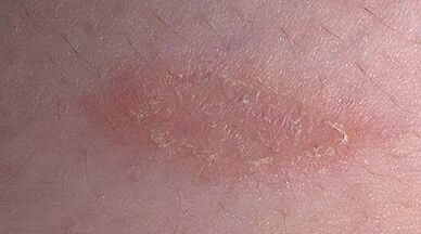 wie und womit man Psoriasis behandelt