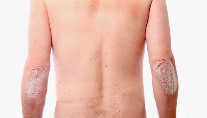 Hausmittel zur Behandlung von Psoriasis