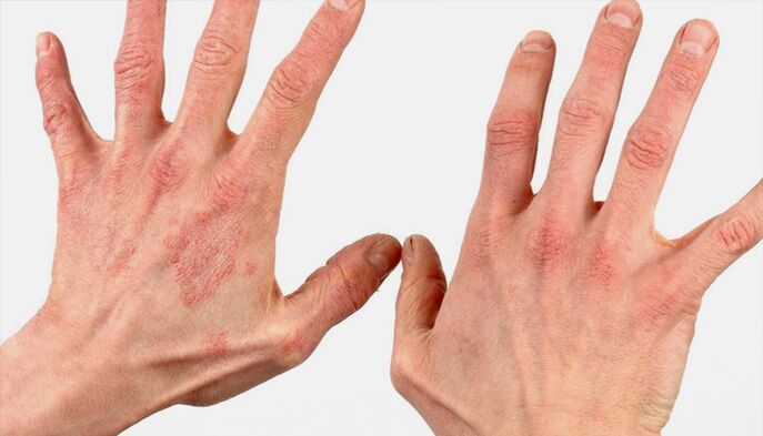 Methoden zur Behandlung von Psoriasis mit Hausmitteln