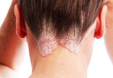 Psoriasis im Kopf