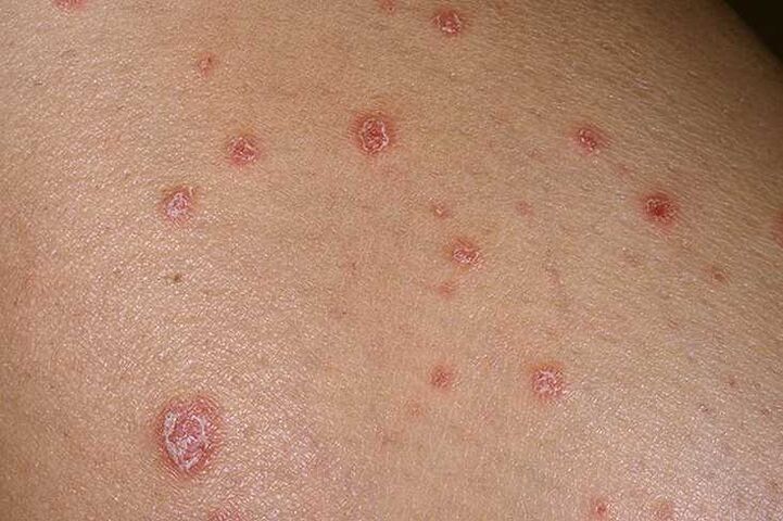 Die Ursachen der Psoriasis