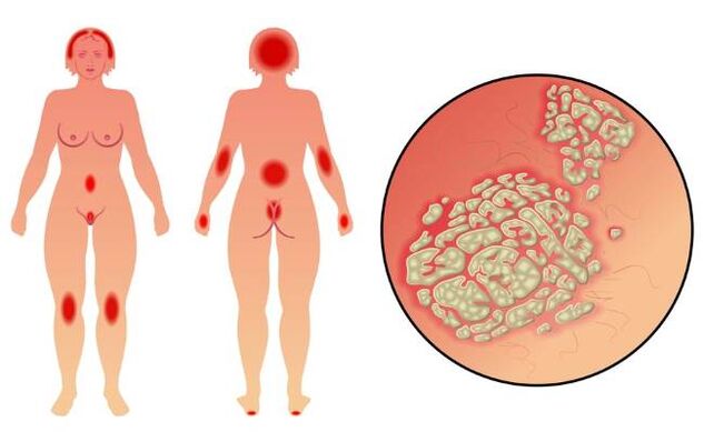 Psoriasis -Symptome