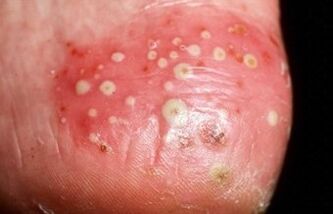 Psoriasis ist pustular