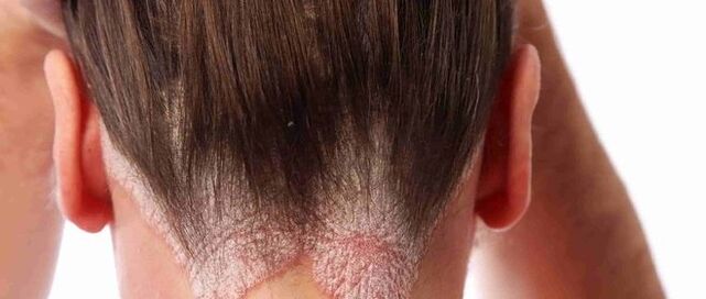 Kopfpsoriasis