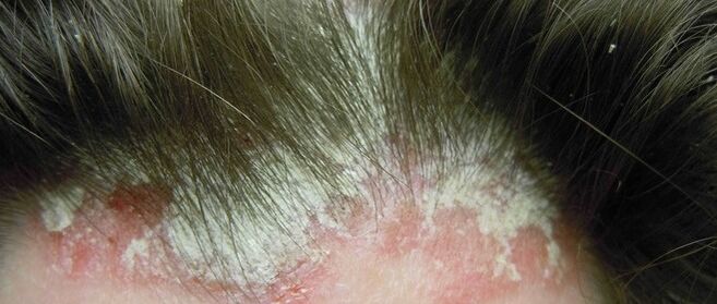 Psoriasis im Kopf
