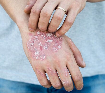 Psoriasis im Arm