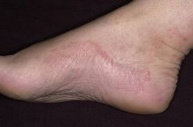 Psoriasis des Fußes