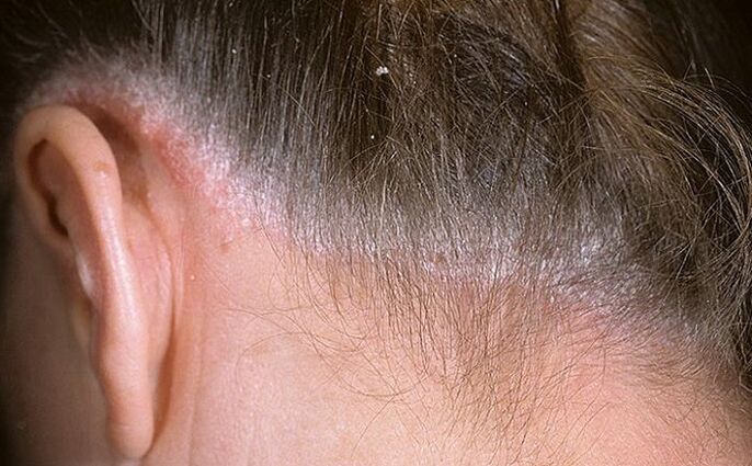 Haarsporiasis