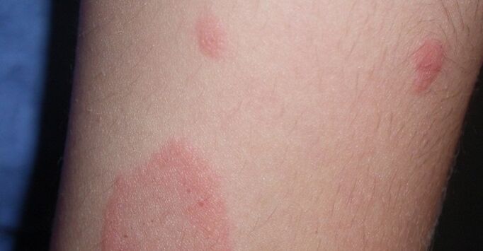 Soriasis