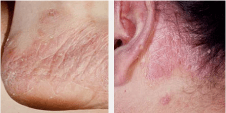Arten von Psoriasis