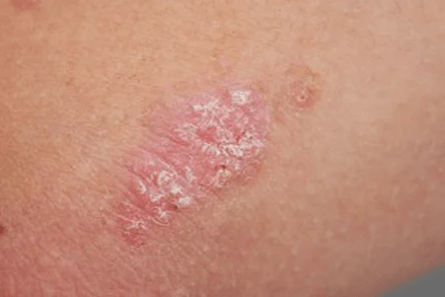 Psoriasis - Anfangsstadium