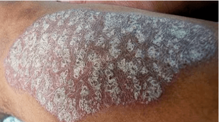 Psoriasis Pathogenese