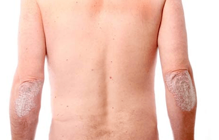 Allgemeine Symptome von Psoriasis