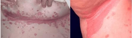 Atypische Psoriasis -Form