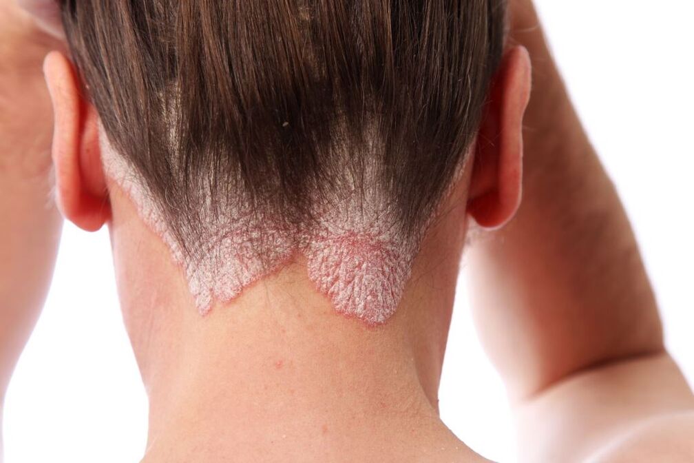 Psoriasis-Behandlung