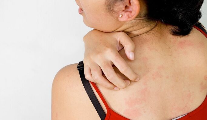 Psoriasis am Rücken
