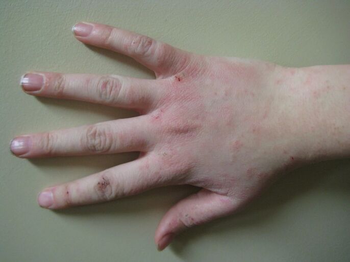 Psoriasis im Frühstadium