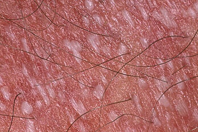 pustulöse Psoriasis