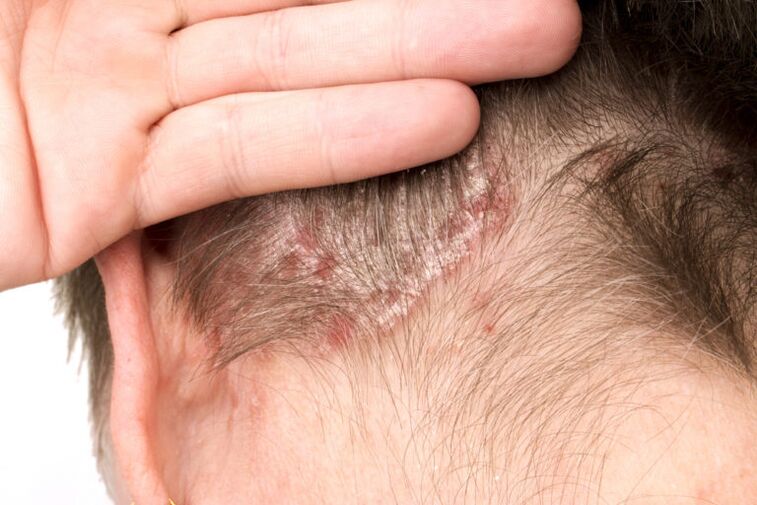 Verschlimmerung der Psoriasis am Kopf.
