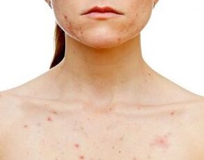 An welchen Körperstellen tritt Psoriasis auf