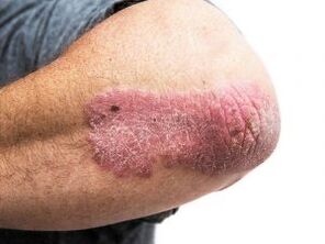Plaque-Psoriasis am Ellenbogen.