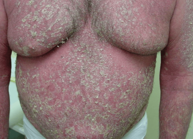 Psoriasis-Erythrodermie am Körper.