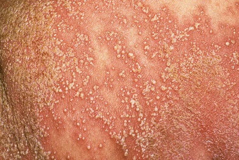 pustulöse Psoriasis