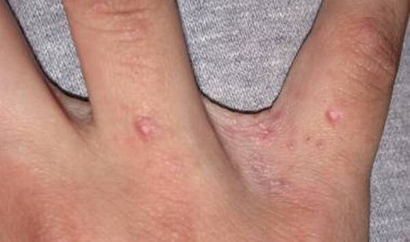 Der Beginn der Psoriasis