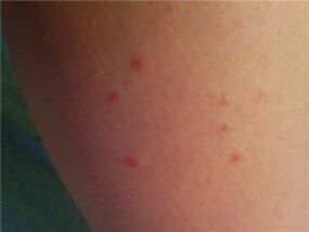 Psoriasis auf der Haut