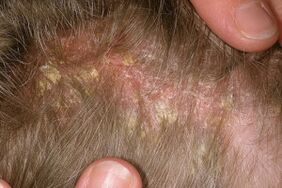 Psoriasis im Kopf