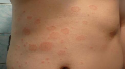Psoriasis im Körper